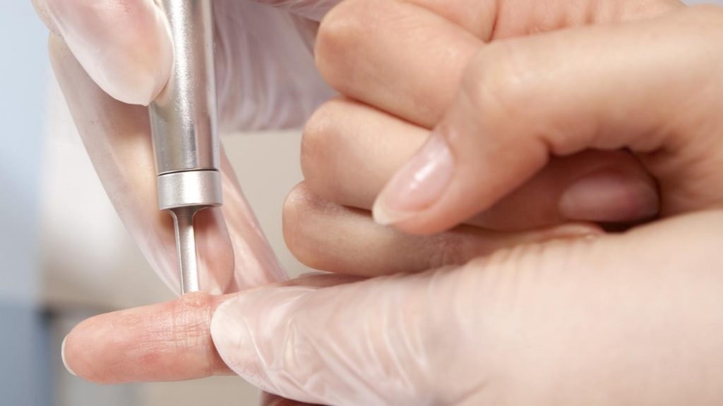 cách trị mụn cóc